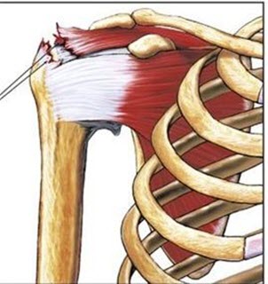 Rách gân cơ chóp xoay khi chơi tennis Rách gân cơ chóp xoay khi chơi tennis
